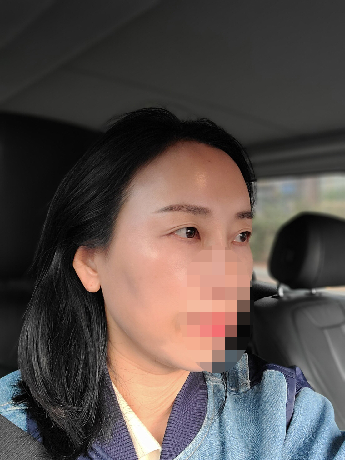 수술 2달 후기예요 지방2차 이식까지 끝냈어요.