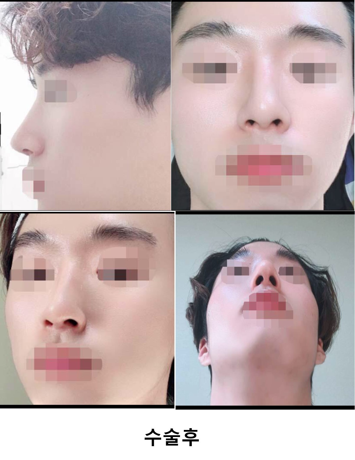 매부리 성형후기