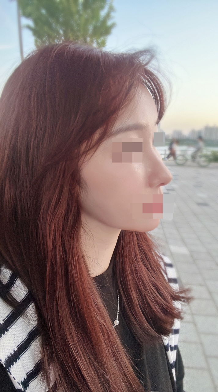 더 자연스럽고 예쁜 코로 변하고 있어요!!