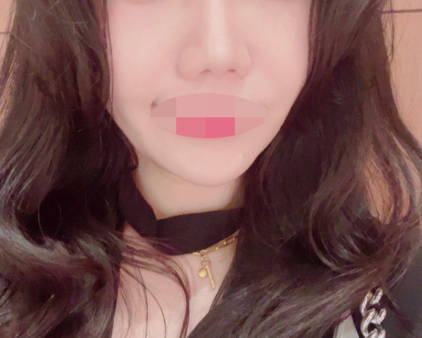 처음이라 걱정했는데 수면으로 편하게 리쥬란힐러 받았어요~