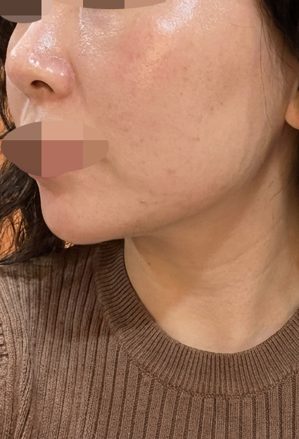 온다 리프팅 받았는데 친절하고 로테이션 빨라서 또 오려고요 ㅎㅎ