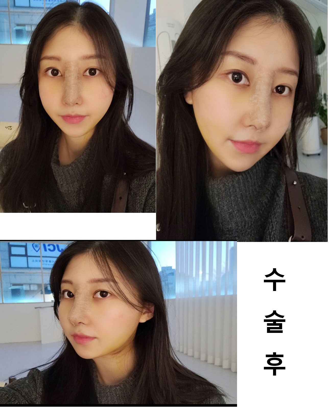 서울아이에서 코수술ㅎ