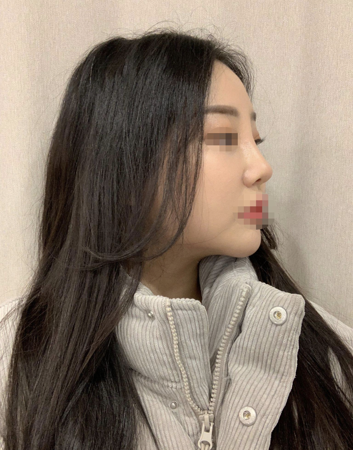 수술하기 잘했단 생각을 매번해요
