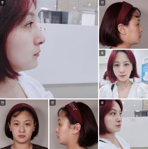 서울아이 코수술 비법 대공개!!!
