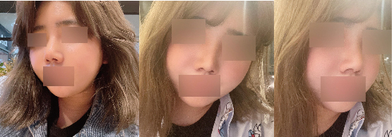 얼굴지흡, 코수술 한달후기임당~