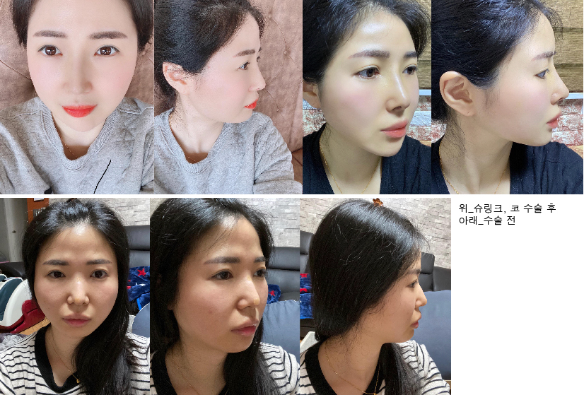 코수술,사각턱 보톡스,슈링크 후기에요~