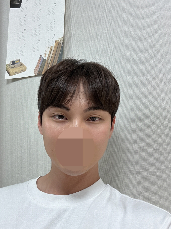 평평하던 눈밑과 얼굴 볼륨감을 채워서 좋아요