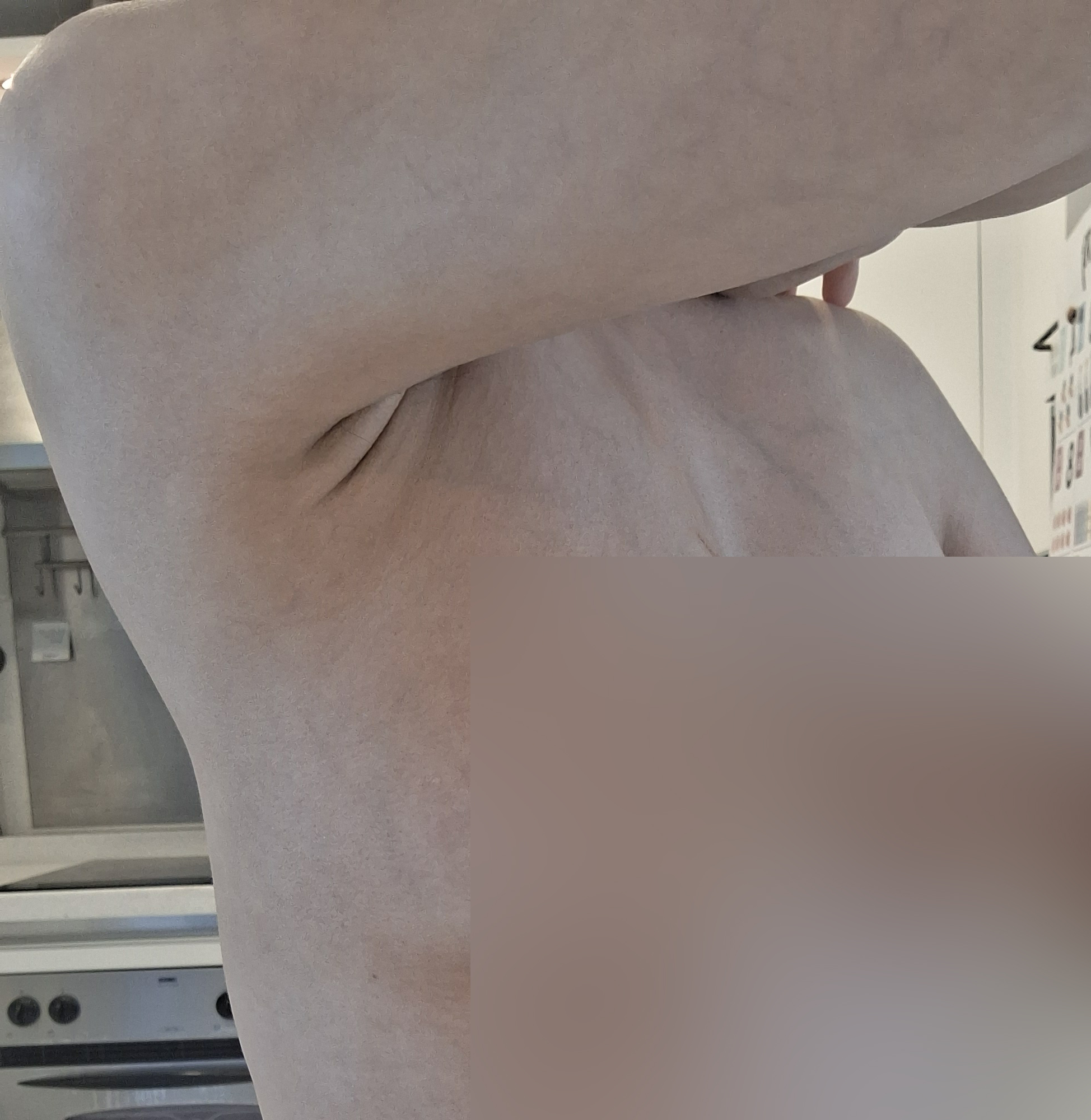 브라라인 지방흡입 1달차, 회복도 결과도 만족