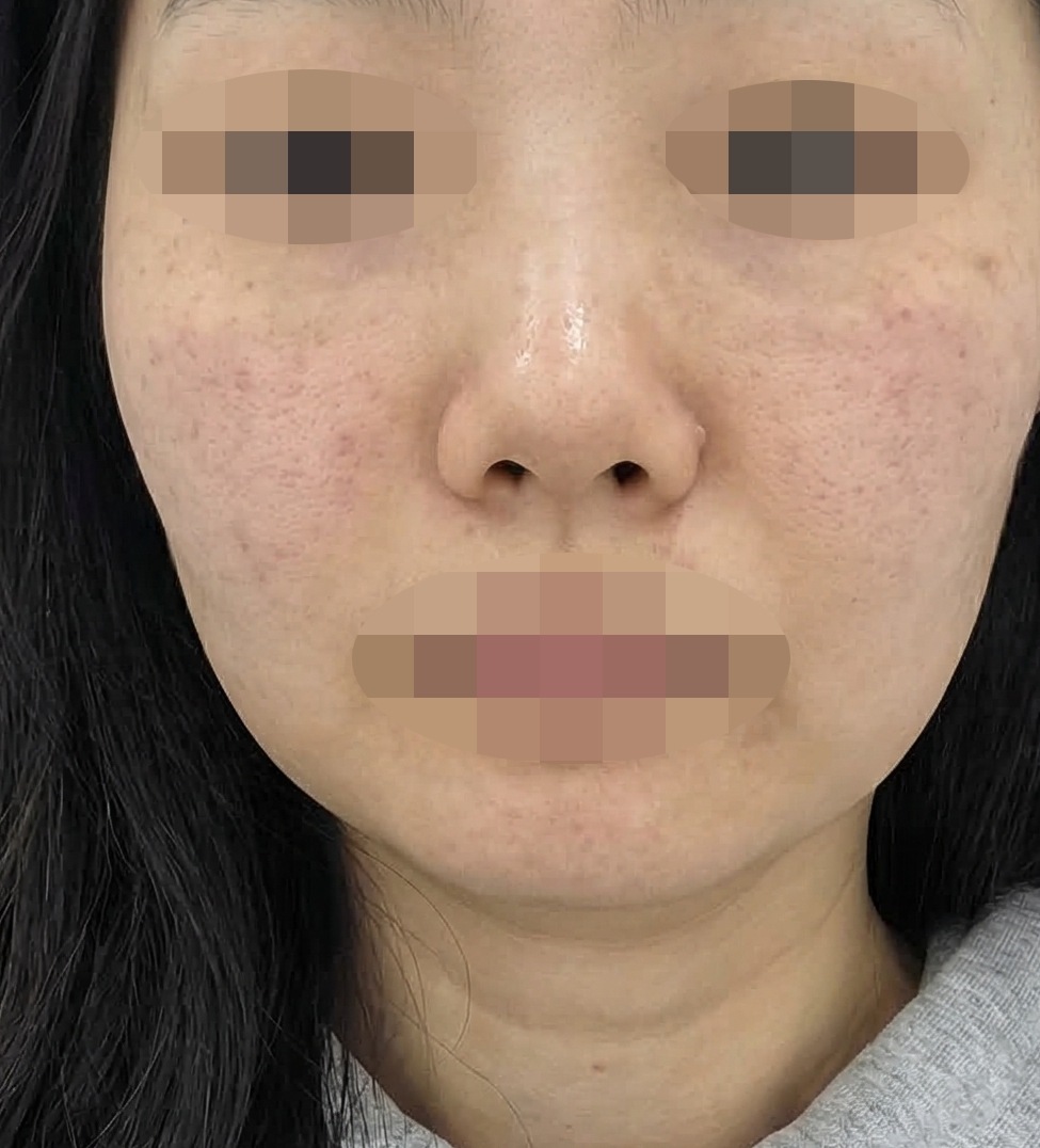 건조해서 리쥬란 받았는데 대기 없고 친절해서 좋았어요!
