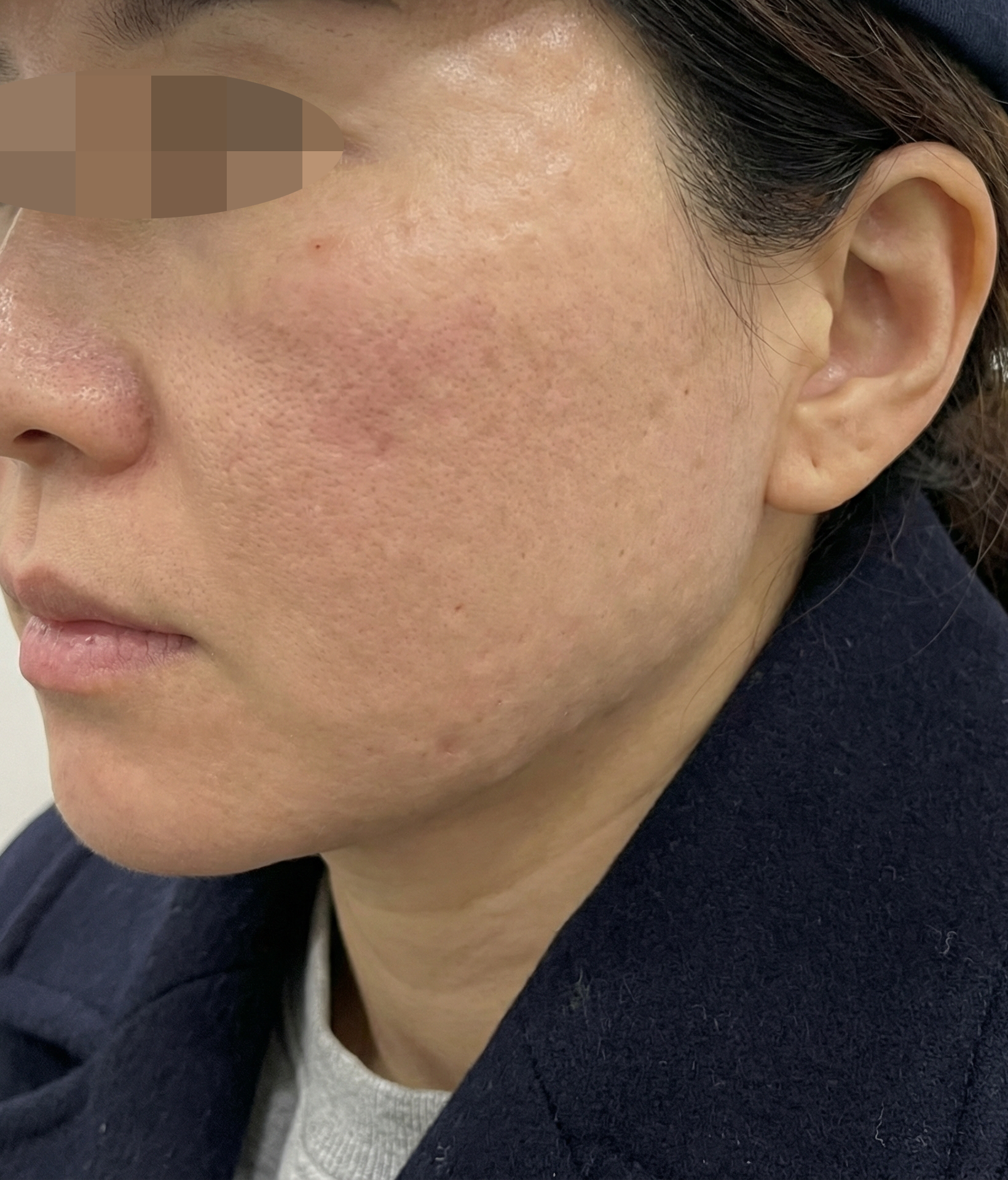 리쥬란 주기적으로 받는 이유ㅎㅎ 엠보 촘촘하고 효과 좋아서 계속 다닙니다~
