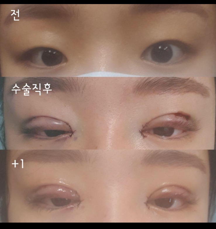 눈매교정 쌍수후기~!