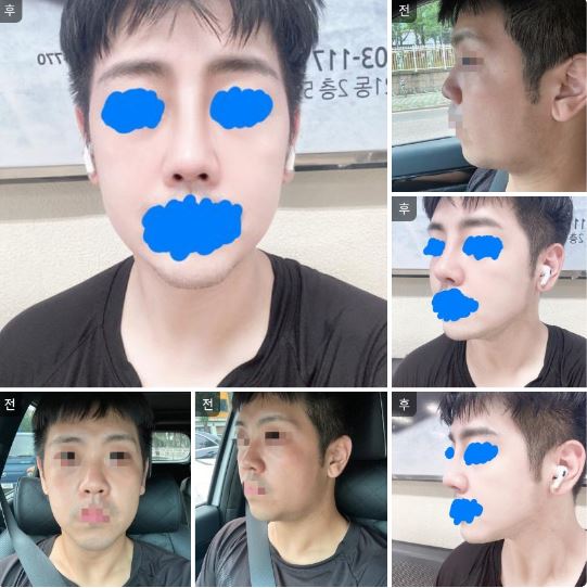 코 성형했습니다, 만족스럽습니다