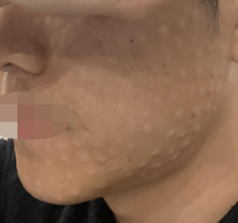 마취 크림 덕분에 통증 부담 없이, 꼼꼼한 시술까지 만족이에요.