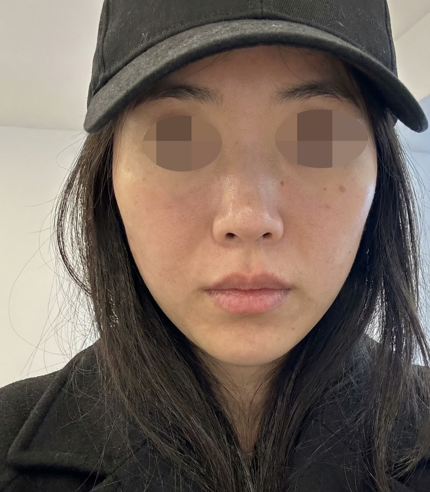 엠보 걱정했는데 진정관리 끝나니 일상생활 바로 가능해요ㅎㅎ