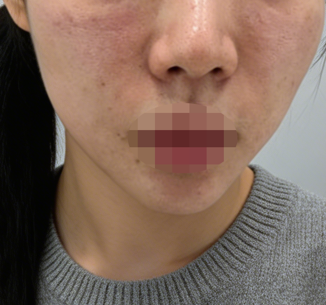 리투오 받았는데 바로 일상 복귀 가능하고 만족이에요~ 그리고 친절하고 꼼꼼해서 편하게 받았습니다!