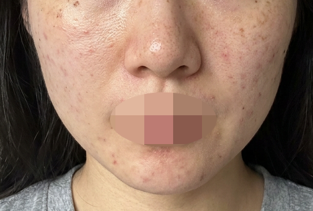 수면으로 받으니 안 아프고 편해서 선택하길 잘했어요ㅎ
