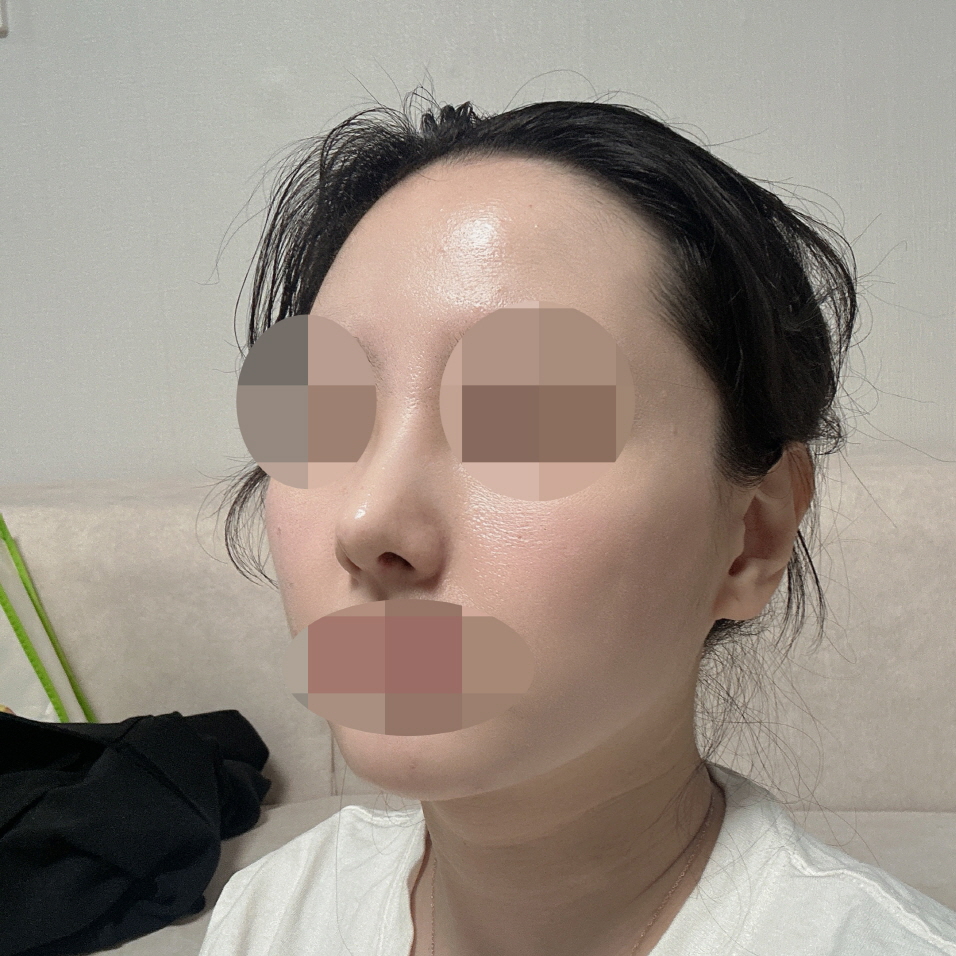 옆모습 콤플렉스 없어져서 너무 만족스러워용