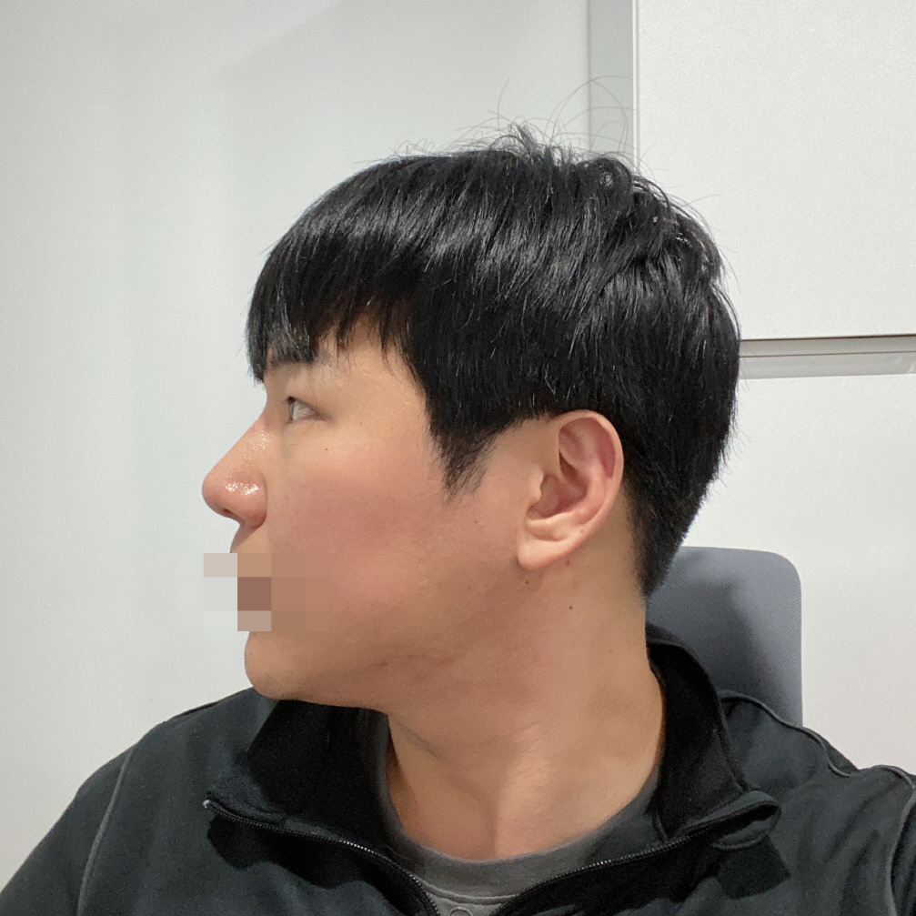 너무 마음에 들고 붓기 더 빠지면 어떻게 될지 기대됩니다!