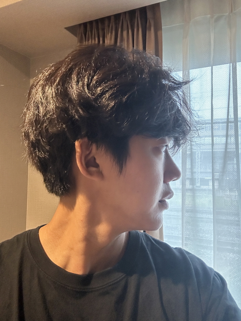 흉도 거의 없어지고 코모양도 잘됐고 기능코 효과가 진짜 너무 좋습니다!