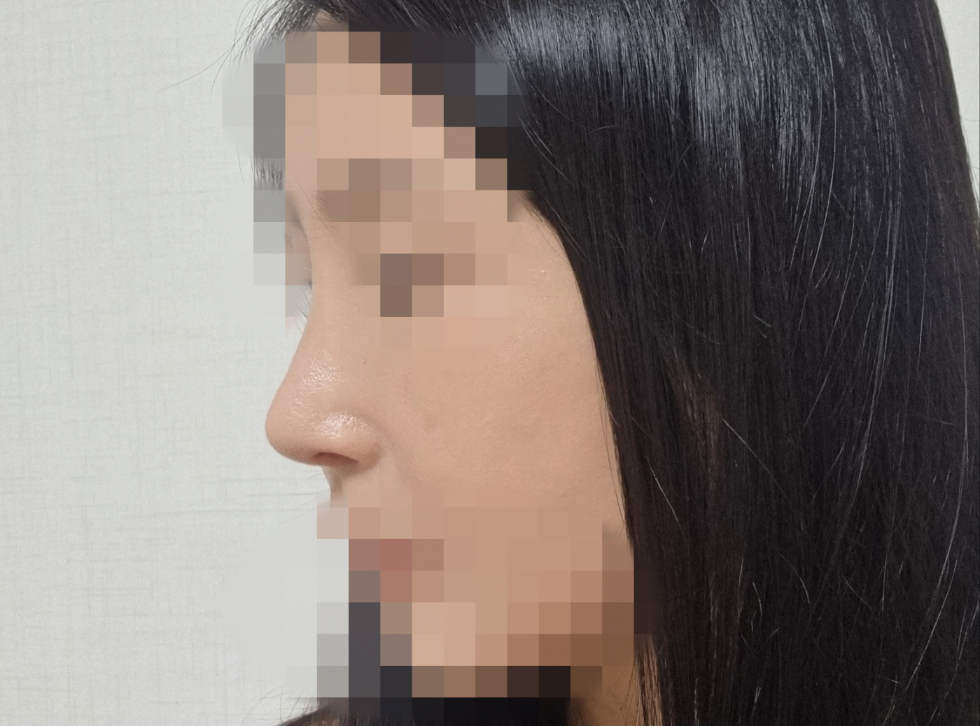 수술 2달째입니다~ 큰붓기는 어느정도 가라앉았어요.