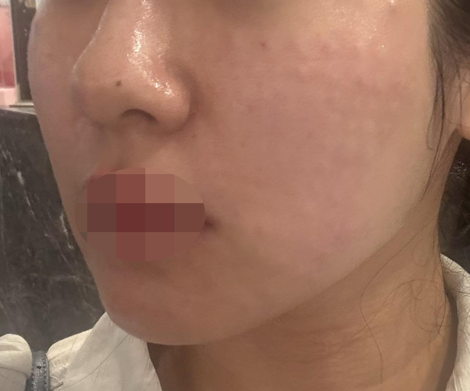 다른 곳에서 멍 많이 들었는데 여기서 리쥬란 받으니 완전 달랐어요!