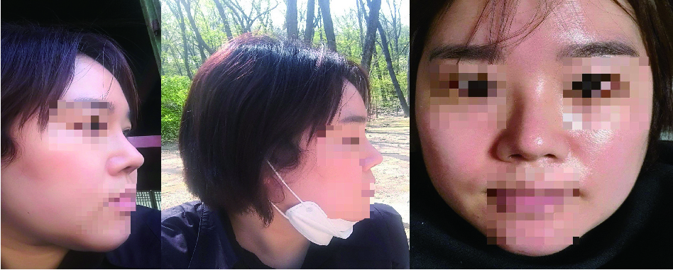 서울아이 낮은코 복코 성형 후기