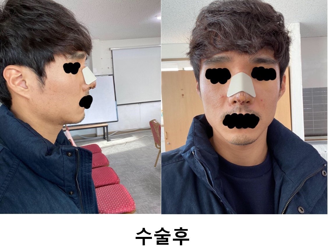 매부리코 수술