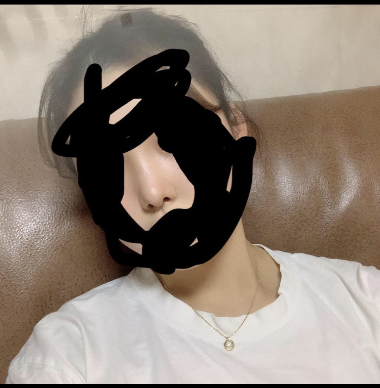 들창코 복코 수술