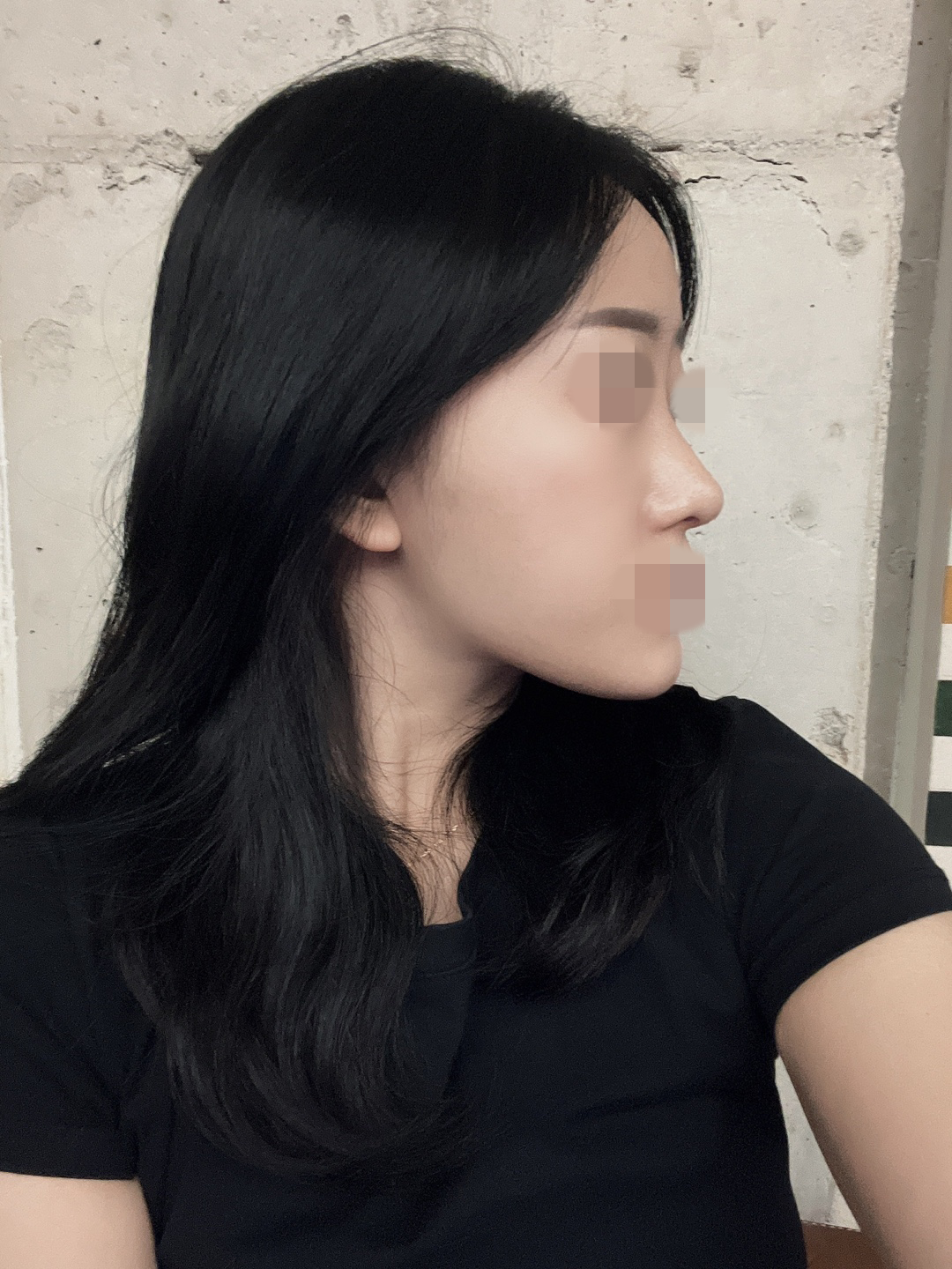 황정일 원장님께 코 수술 받은지 한달차 되었습니당!