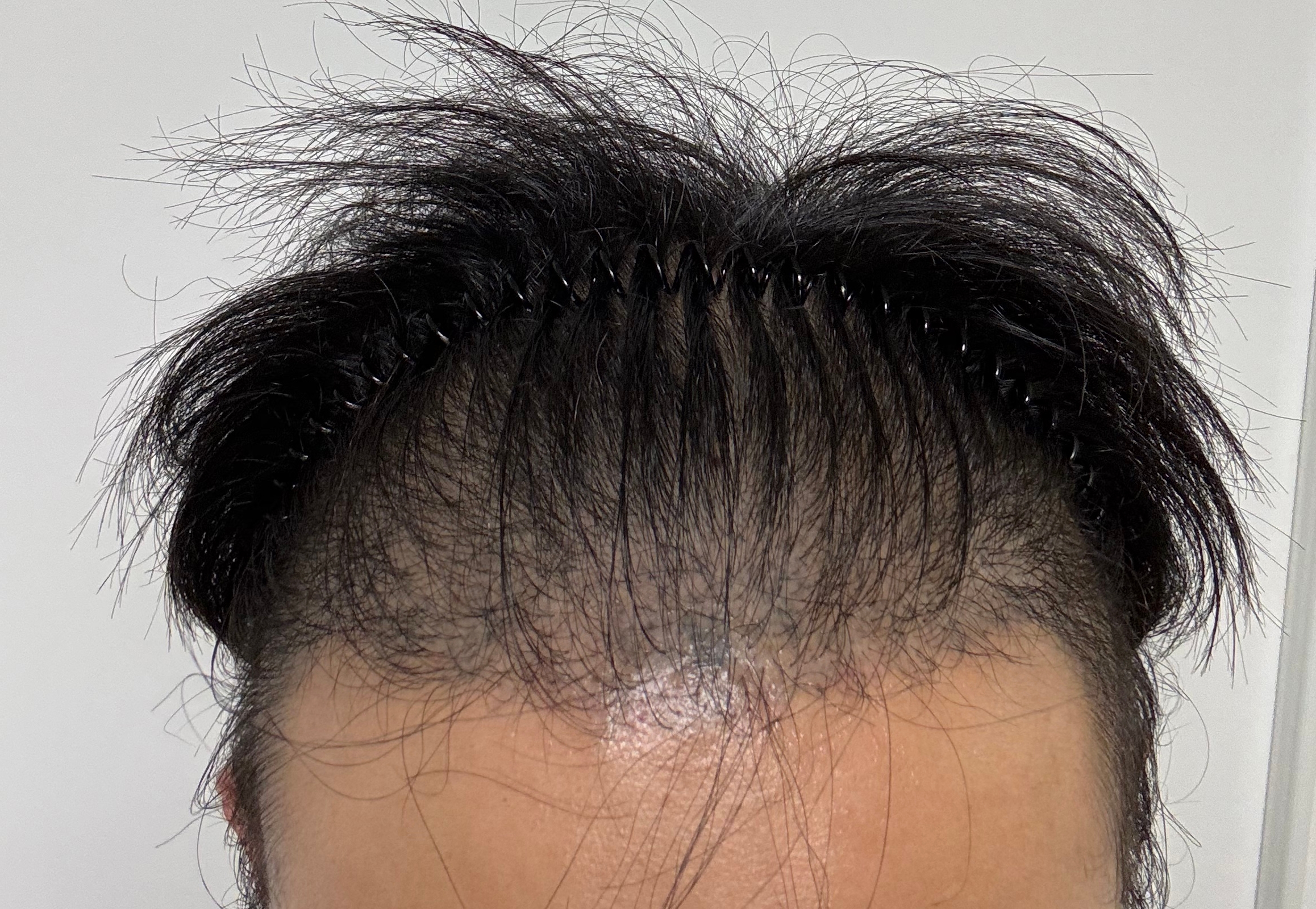 비절개 삭발 모발이식 4개월, 기다린 보람이 있네요