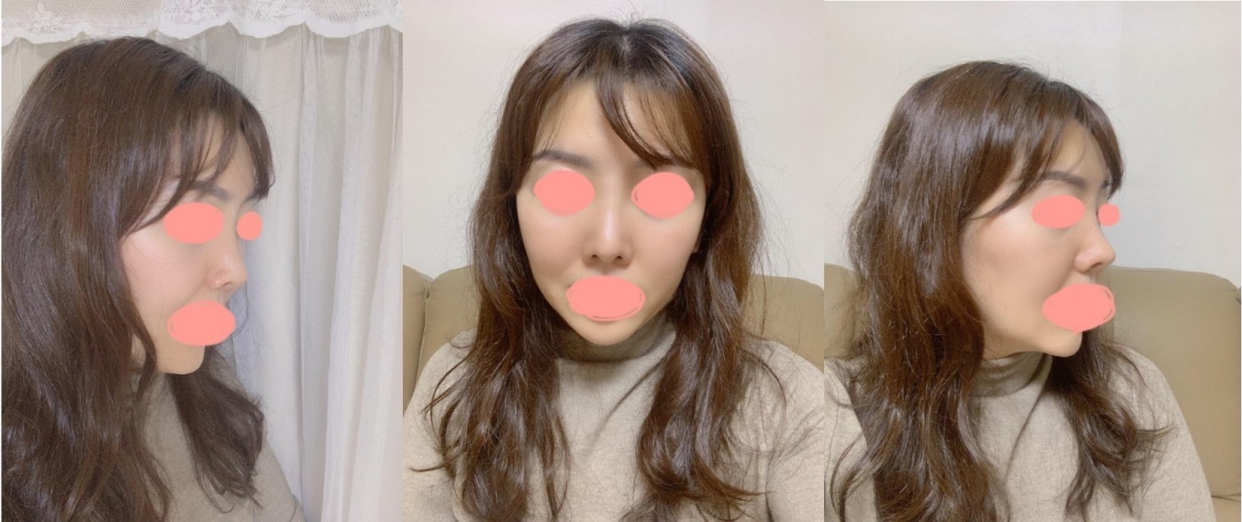 코재수술 후기