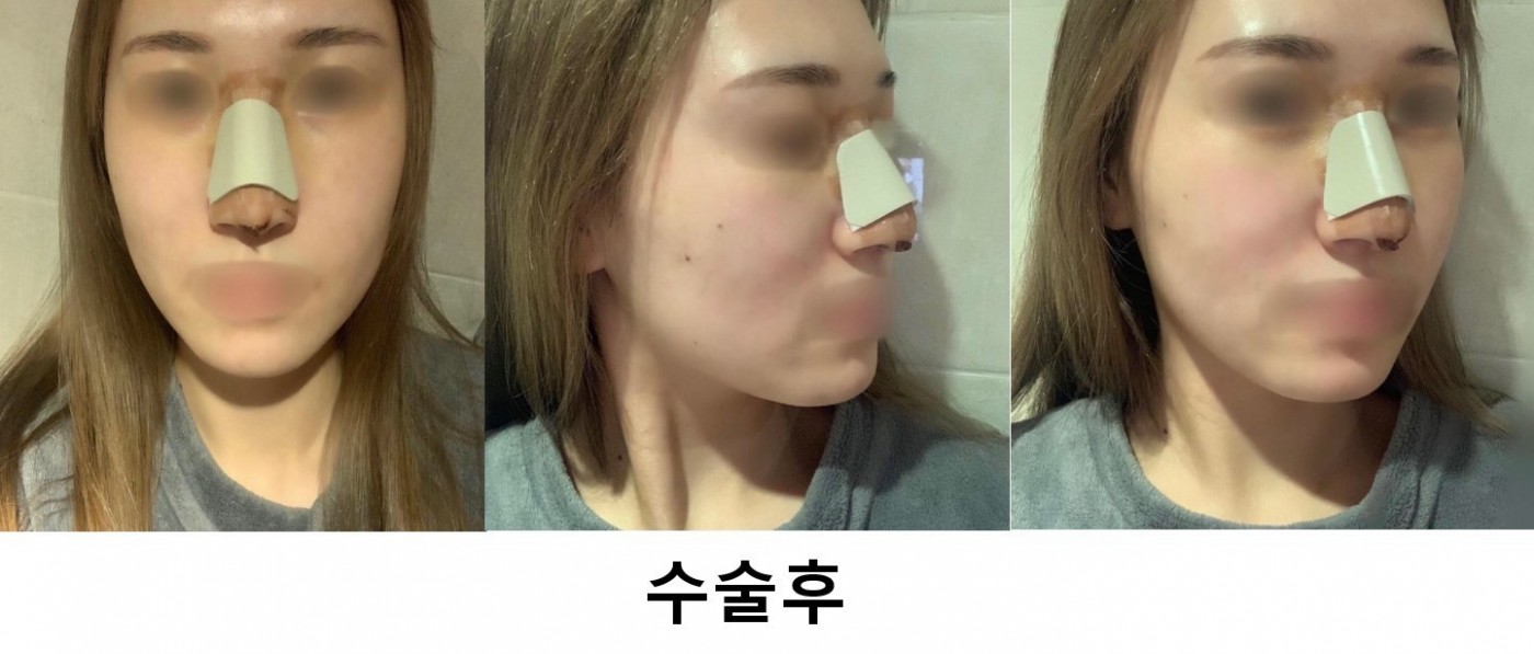 매부리 수술했어용