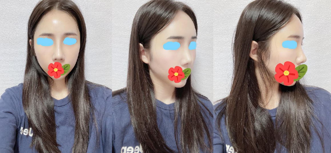7월31일 수술후 올리는 따끈한 후기