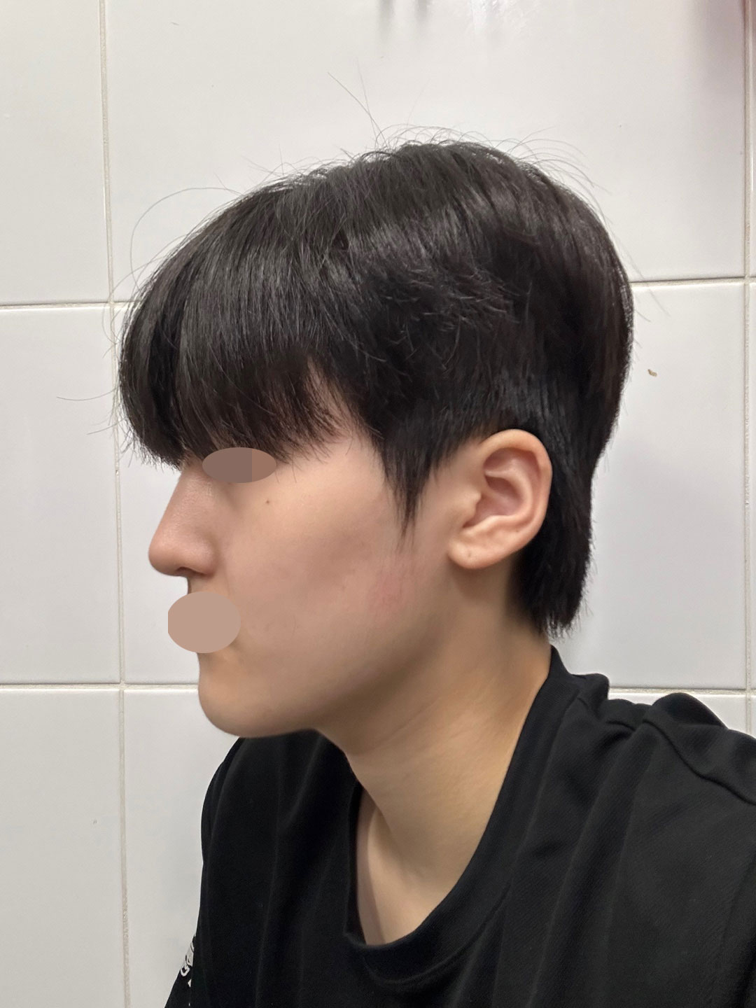 스트레스 받던 휜 코가 일자가 되니 너무 예쁘고 좋아요 :)
