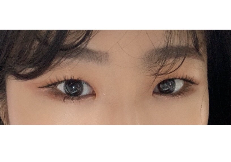 눈매교정, 쌍수