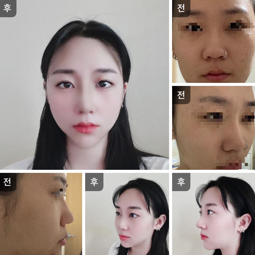 매부리코,복코 7일간 수술후기!