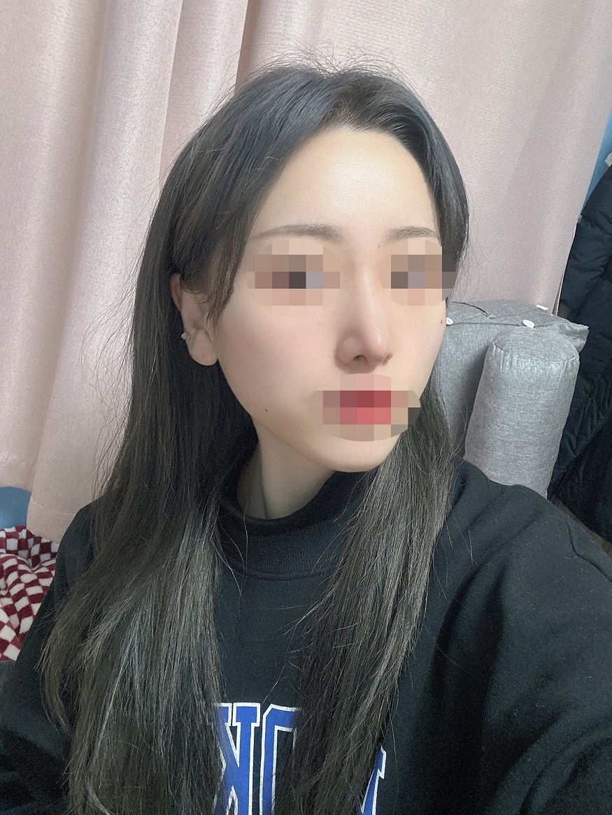 메부리 절골 코끝(비중격연골) 수술한지 2주차 되었습니다!