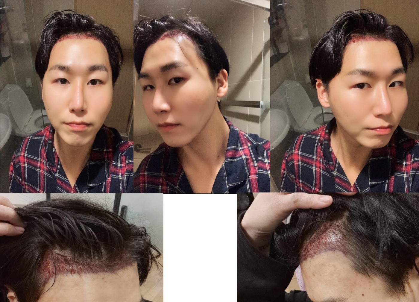 모발이식, 리프팅 했습니다