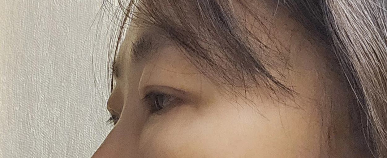 눈밑지방제거·상하안검 2주차 후기