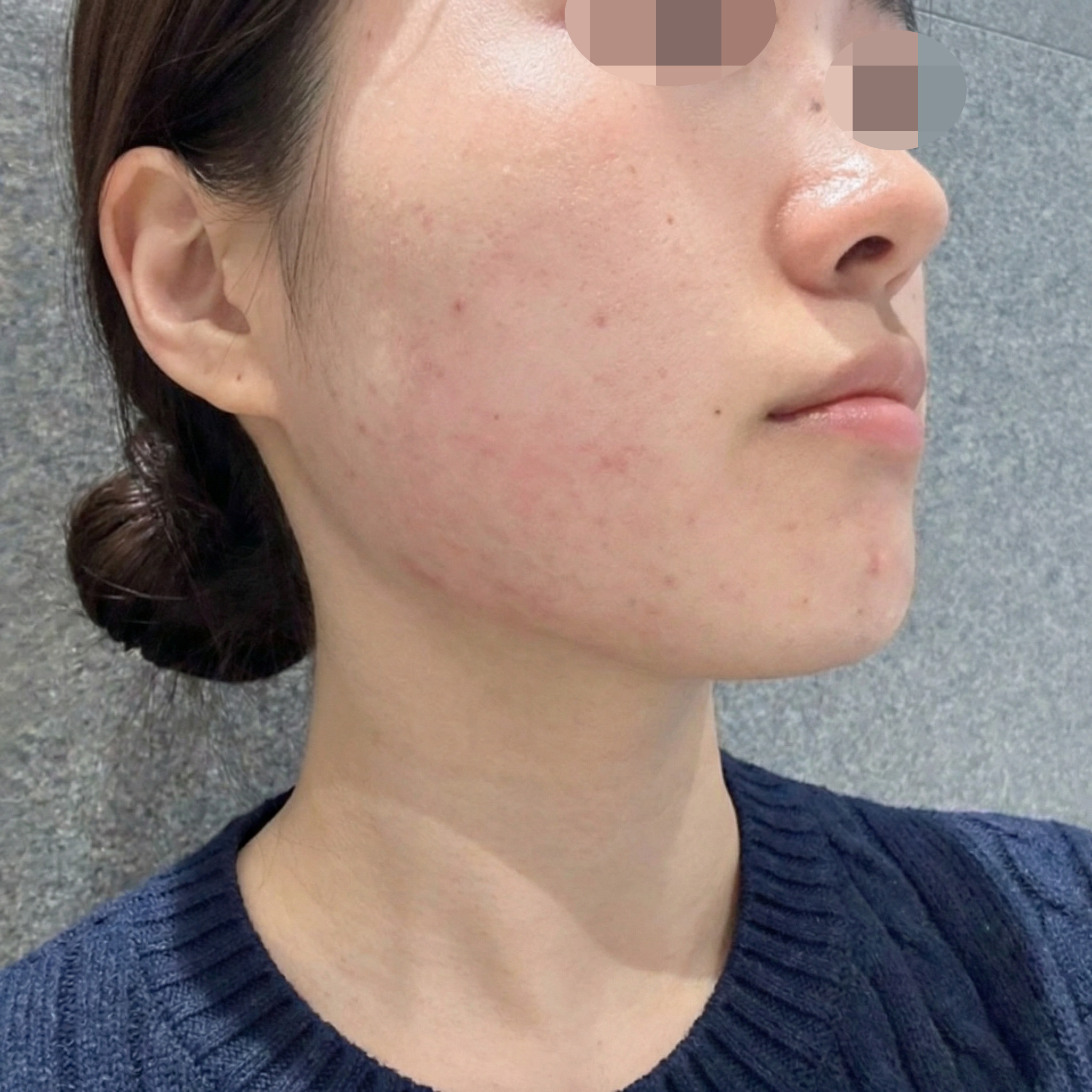 과한 권유 없이 차분한 상담, 슈링크 결과도 만족이에요