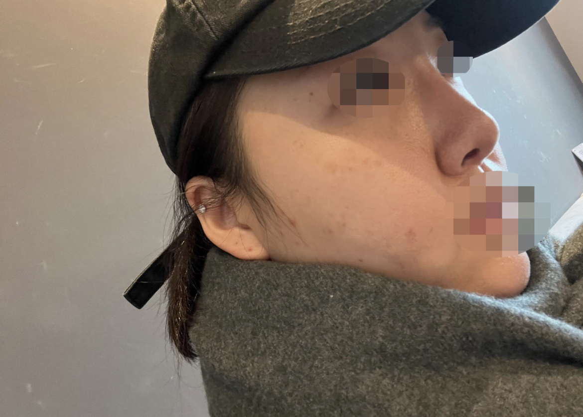 콧대도 살아나고 자연스럽게 잘 된거 같아요!