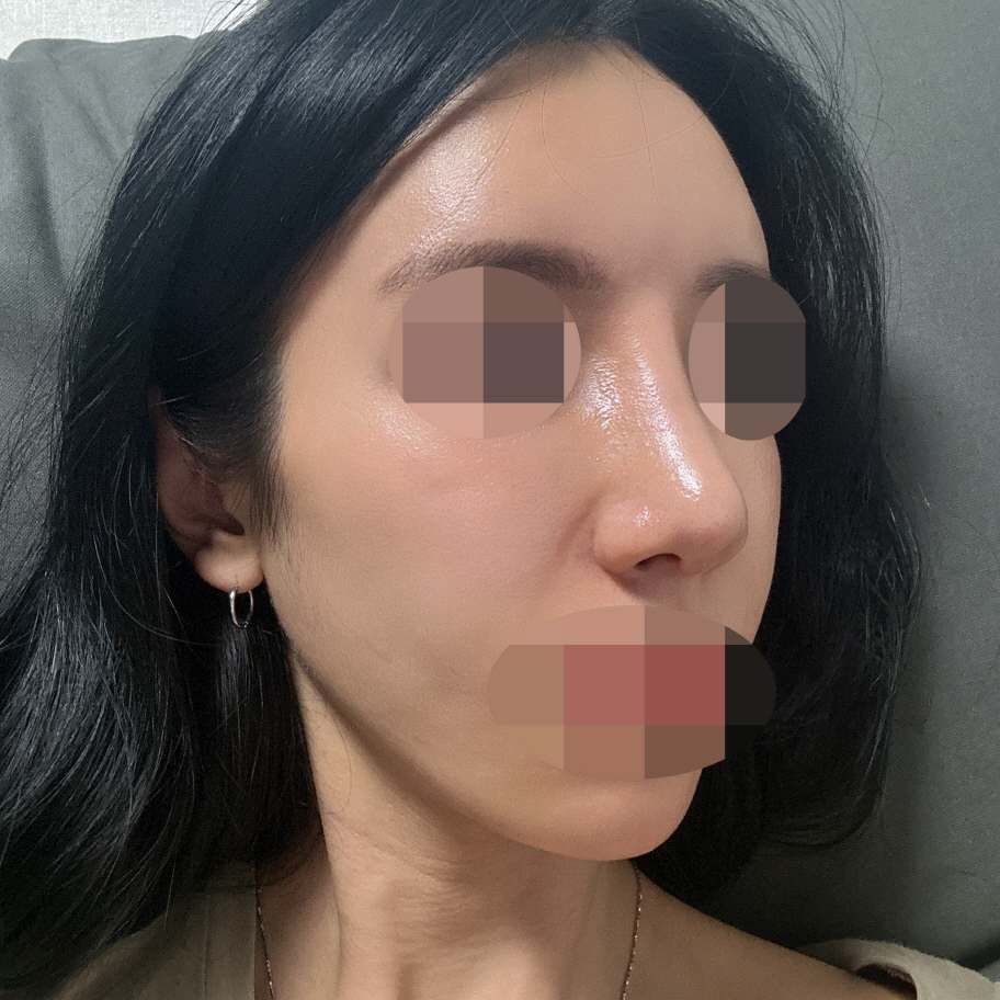 아직 2주차라 붓기는 더 빠져봐야 알것 같지만 더더 예뻐질 것 같아요