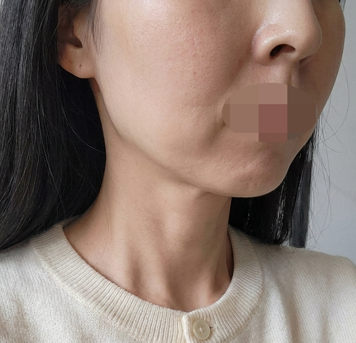 얼굴 라인 고민으로 온다리프팅 받았는데 확실히 달라진 느낌이에요~