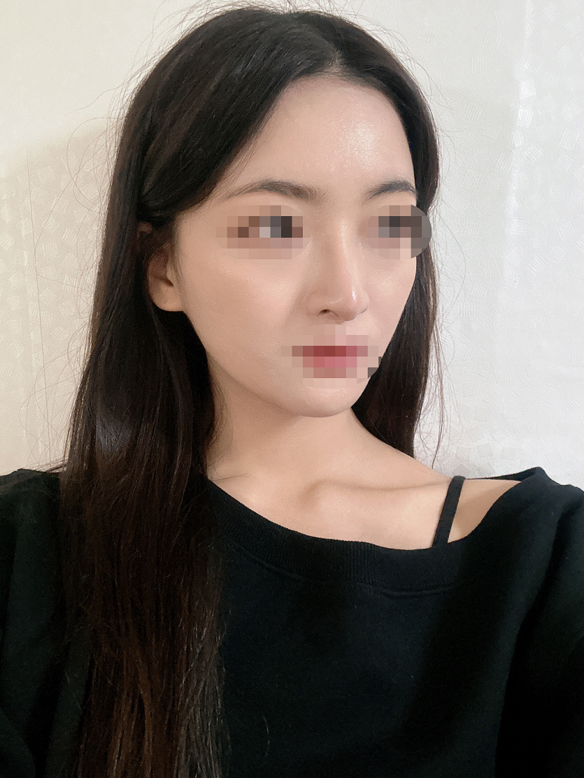 결론적으로 코가 정말 작아졌고 화살코도 상당히 교정됐어요! 너무 만족해요