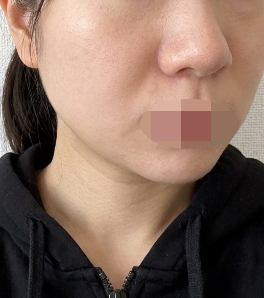 피부 탄력 위해 시작한 쥬베룩, 만족스럽게 받고 왔어요