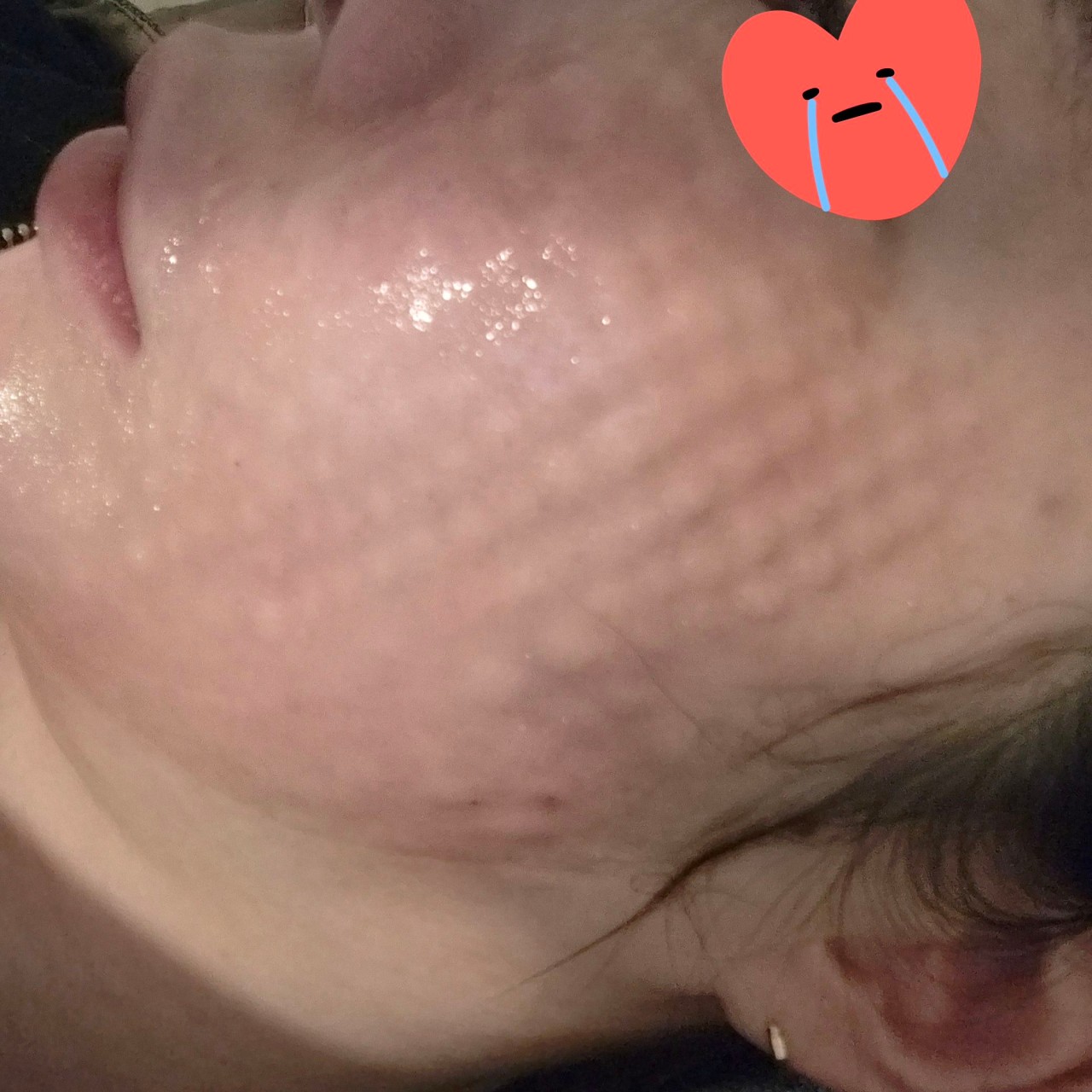 여태 받은 시술 중에 제일 만족인 것 같아요ㅎㅎ