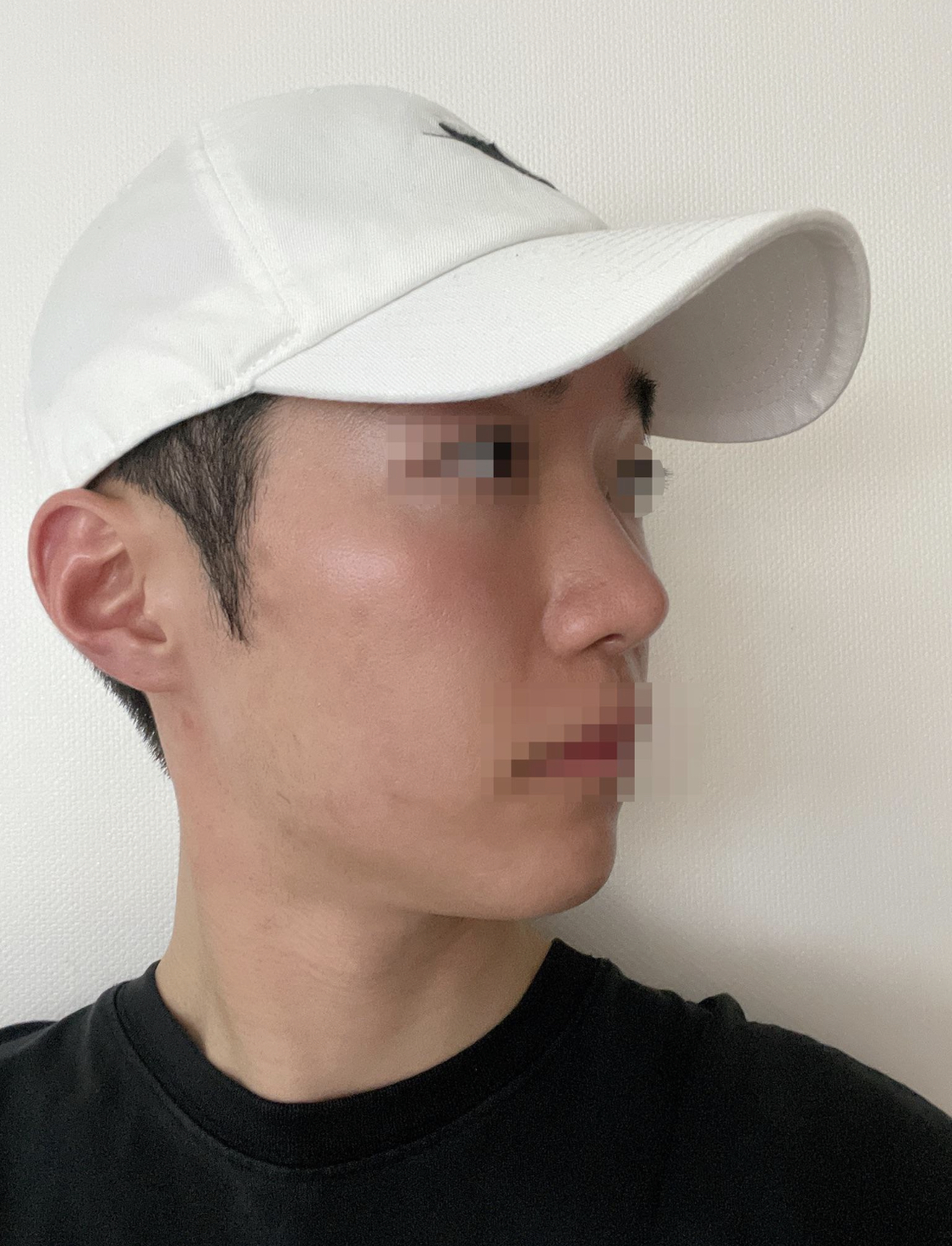 수술받은지 3개월차입니다.