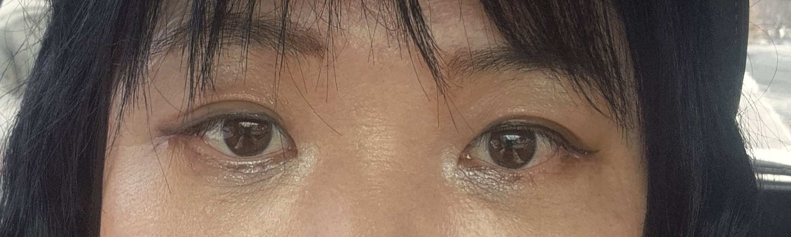 하안검·눈밑지방이식 2차 1달차, 자연스럽게 달라진 눈밑