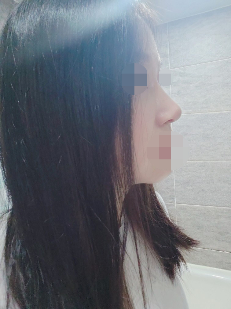 코수술 하시려면 서울아이성형외과 추천해요!!