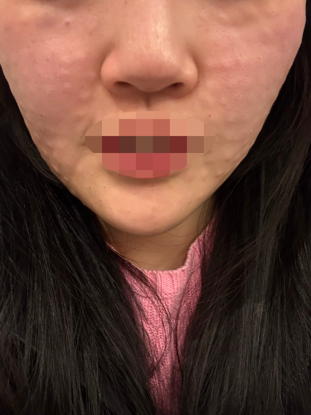 리쥬란 처음인데 엠보 잘 나오고 효과 좋을 것 같아서 기대하고 있어요~